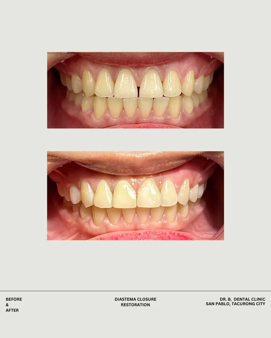 Gap-closing dental treatment result shared by DR. B. Dental Clinic
