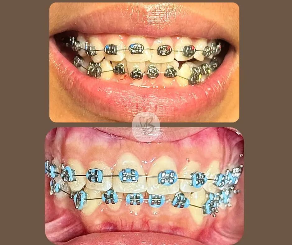 Orthodontic treatment progress shared by DR. B. Dental Clinic