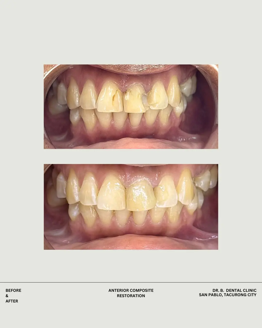 Tooth restoration result shared by DR. B. Dental Clinic